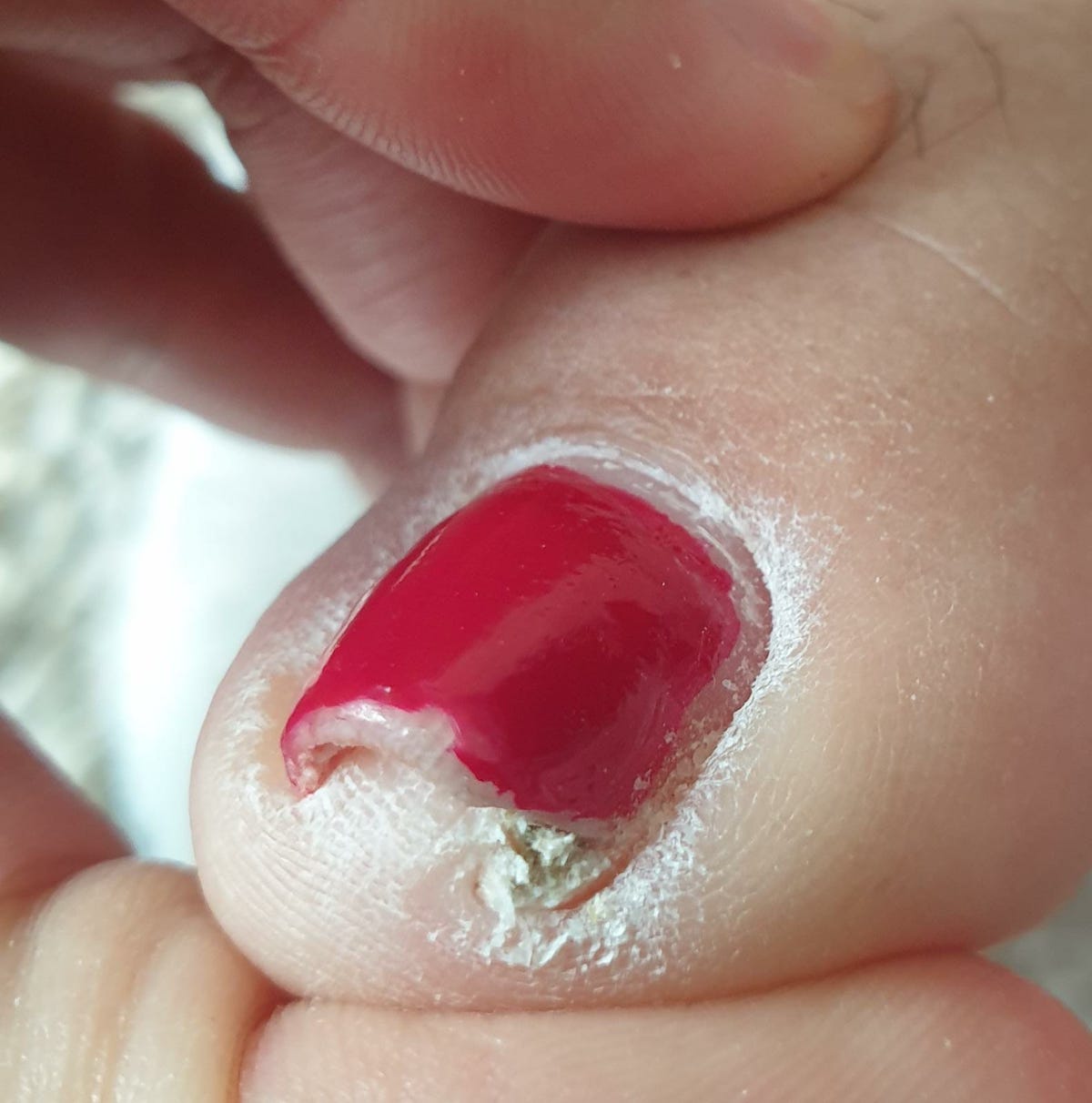 FOOT DOCTORS  Uña Encarnada  Se produce con mayor frecuencia en el  primer dedo del pie que en los demás  Manejamos 3 tipos de  tratamientos para la uña encarnada 
