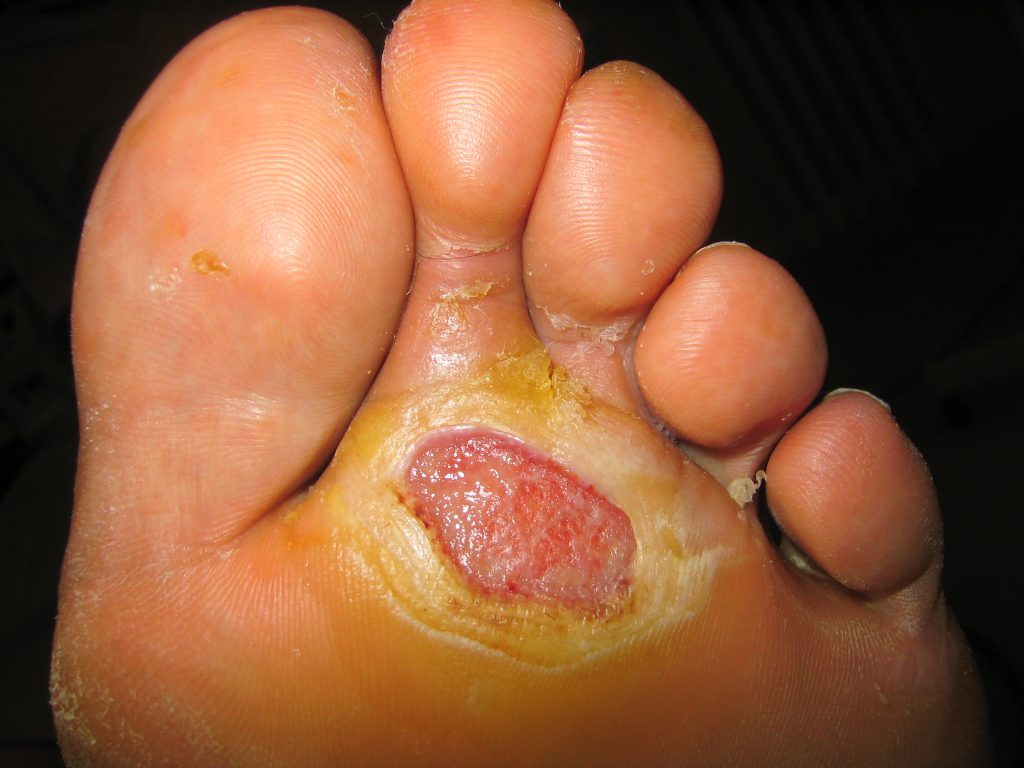 sindrome del pie diabético